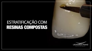 ESTRATIFICAÇÃO COM RESINAS COMPOSTAS PASSO A PASSO [upl. by Brenton188]