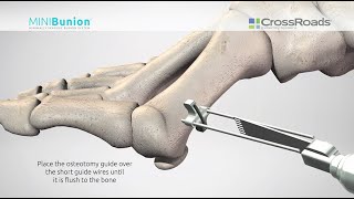 Minimally Invasive Bunion Surgery with CrossRoads MINIBunion™ System  Surgical Animation [upl. by Ahcorb580]