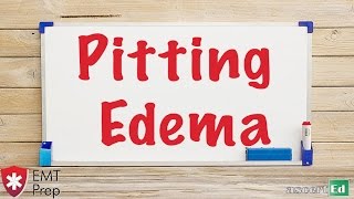 Pitting Edema  EMTprepcom [upl. by Yatnahc]