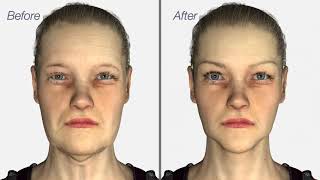 Facelift amp Neck Lift surgery  Dr Julian De Silva  3D medical animation [upl. by Blasius]