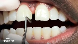 How Tooth Gaps Are Filled  Insider Art [upl. by Chem]