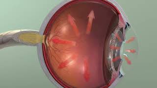 Animation Glaucoma [upl. by Leizar]