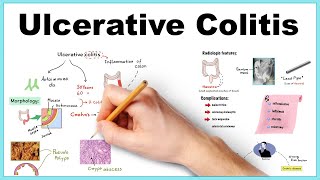 GEducainflamatoria  ¿Que es una COLITIS ULCEROSA [upl. by Eidassac267]