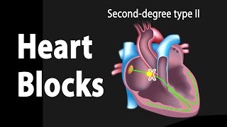 Heart Blocks Anatomy and ECG Reading Animation [upl. by Loux85]