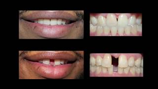 Invisaign for Teeth Gap Treatment at Cosmetic Dental Associates [upl. by Camile49]