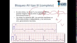 Arritmias en el electrocardiograma [upl. by Yartnoed]