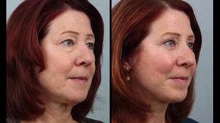 Day By Day Weekend Mini Facelift amp Blepharoplasty Recovery [upl. by Anoli818]