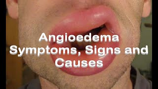 Angioedema  Symptoms Signs and Causes [upl. by Aiyot226]