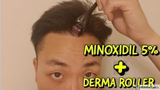 HOW TO USE DERMA ROLLER AND MINOXIDIL FOR HAIR GROWTH [upl. by Naerol406]