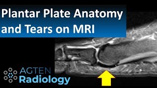 How to Assess Plantar Plate Anatomy and Tears on MRI [upl. by Paola]