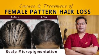 Female Pattern Hair Loss  Causes amp Treatment in 10 minutes [upl. by Reave278]