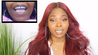 How To Close Gap Teeth Without Braces In 45 Mins  My Dental Bonding Experience [upl. by Younglove]