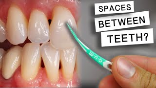 Do Floss Picks Cause Spaces Between the Teeth or Black Triangles [upl. by Starling]