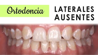 AGENESIA DENTAL  TRATAMIENTOS LATERALES SUPERIORES AUSENTES [upl. by Bega962]