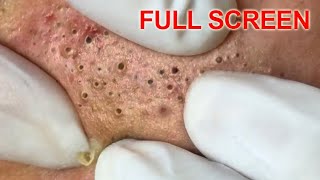 Blackheads removal  Best Pimple Popping Videos [upl. by Nealey]