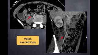 Infections urinaires  3 Pyélonéphrite aiguë  TDM [upl. by Nakasuji942]