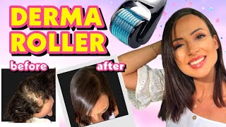 DIY TREATMENT DERMA ROLLER FOR HAIR LOSS  MIRACLE SECRET CURE [upl. by Nwahsav525]