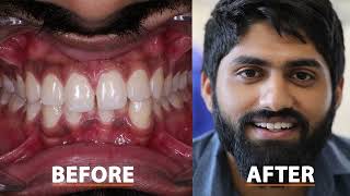 How to close Gap between teeth  Composite Bonding  FMS Dental Hospital  Hyderabad India [upl. by Gretta]