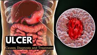 Ulcerative colitis  Morphology Clinical features difference from Crohn disease [upl. by Raji]