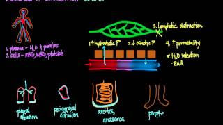 Disorders of Circulation Edema [upl. by Concoff]