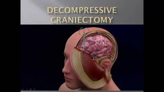 DECOMPRESSIVE CRANIECTOMY DC [upl. by Annek]