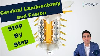 Posterior Cervical Laminectomy and Fusion  Procedure details recovery and expectations [upl. by Eeryn171]