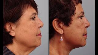 Day by Day Facelift amp Necklift Recovery [upl. by Naelcm605]