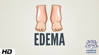 Edema Causes Signs and Symptoms Diagnosis and Treatment [upl. by Ellenehs50]