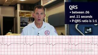 Bradycardia ECG Rhythm Interpretation [upl. by Sirromed903]