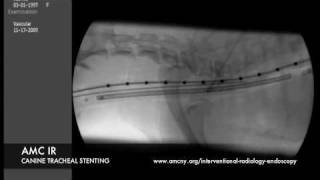 Interventional Radiology Tracheal Stent [upl. by Anailuy]