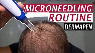 My Microneedling Routine and Derma Rolling for Hair Loss [upl. by Adaven66]