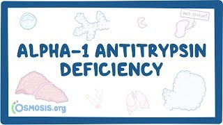 Alpha1 Antitrypsin Deficiency  causes symptoms diagnosis treatment pathology [upl. by Treat]