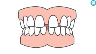 How To Close Gaps Between Teeth Without Braces [upl. by Suhcnip]