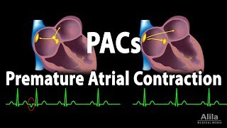 Premature Atrial Contractions PACs Animation [upl. by Halet]