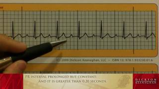 EKG Training An Introduction to Bradycardia  Heart Blocks Part 1 of 3 [upl. by Nesline]