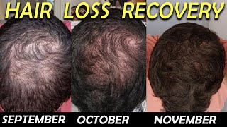 3 Month Hair Loss Reversal with Dutasteride Minoxidil and Saw Palmetto [upl. by Girvin]