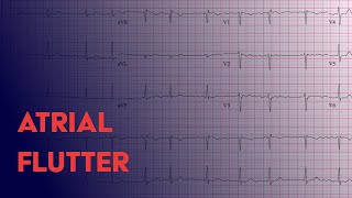 Atrial Flutter  EKG ECG Interpretation [upl. by Brink128]