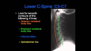 Radiology of Spine Trauma [upl. by Tound]