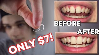 How I Closed The Gap In My Teeth In LESS THAN 1 WEEK DIY Budget Braces  Gap Bands [upl. by Sharity]