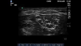 Anaesthesia CME Anatomy of Interscalene Block [upl. by Areis]