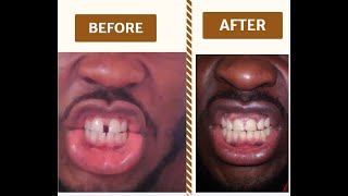 Close Teeth Gap in Only 8 Weeks at Home With Rubber Bands 2020 [upl. by Greff]