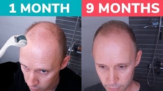 STOP BALDING  Regrow Hair Naturally with Dermaroller Real 9 Month Results [upl. by Sarad]