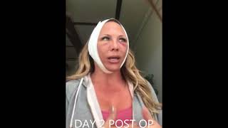 Day By Day Weekend Mini Facelift Recovery [upl. by Codd998]