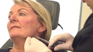 Volumetric Facelift  Nonsurgical full facelift [upl. by Eldoria]