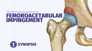 Femoroacetabular Impingement FAI Syndrome  SYNOPSIS [upl. by Neelra]