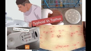 Typhoid vs typhus fever [upl. by Eenahs]