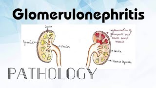 Glomerulonephritis Pathology [upl. by Kcirded]