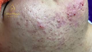 Blackheads Removal 333a  Loan Nguyen [upl. by Munt863]