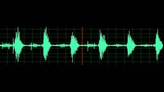 Crackles Pulmonary Edema [upl. by Ydualc597]