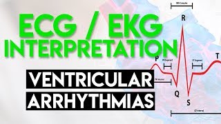 Ventricular Arrhythmias  ECG EKG Interpretation Part 5 [upl. by Theodosia]